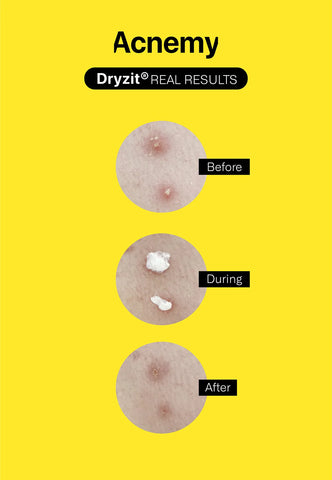 DRYZIT® Dry Lotion