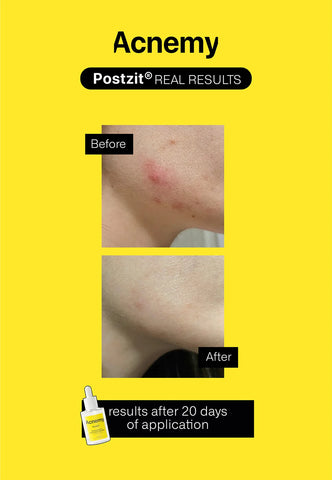 POSTZIT® Zit Marks Solution