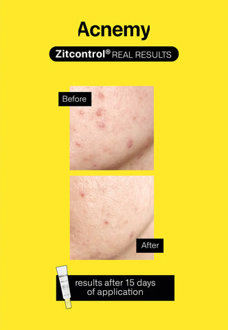 ZITCONTROL® Treatment for acne-prone skin